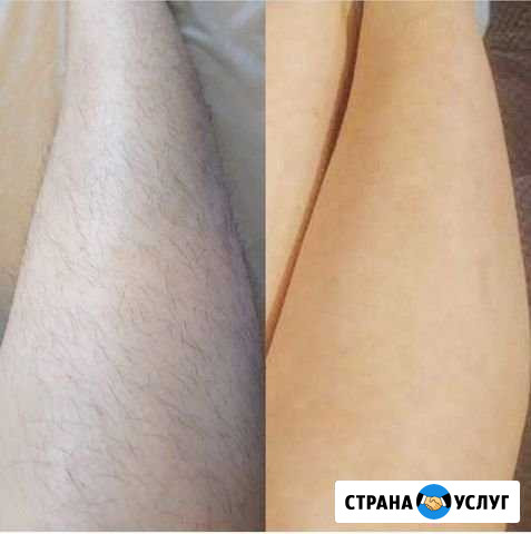 Депиляция Новосибирск - изображение 1