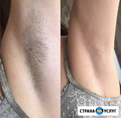 Шугаринг Новочеркасск - изображение 1