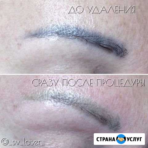 Лазерное удаление татуажа и татуировок, без ожогов Севастополь - изображение 1