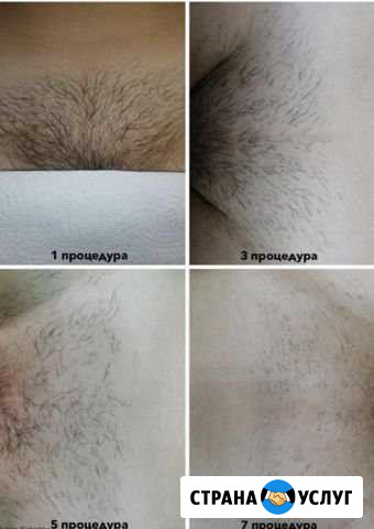 Эпиляция гелем Волгоград - изображение 1