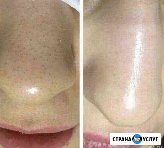 Косметолог, уход за кожей, чистка лица, пилинги Мытищи