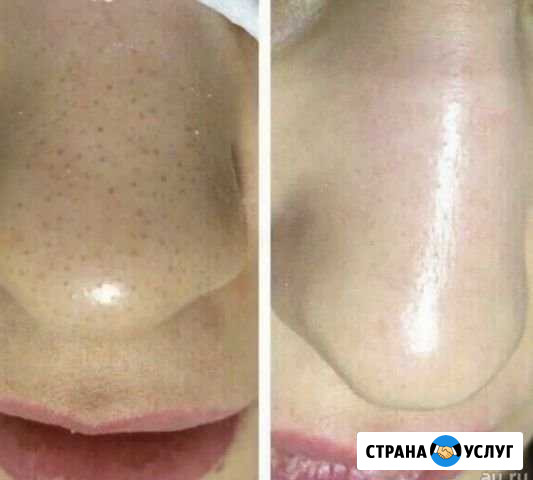 Косметолог, уход за кожей, чистка лица, пилинги Мытищи - изображение 1