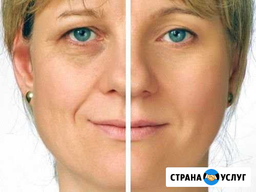 РФ-лифтинг лица, курс 10 сеансов Ачинск - изображение 1