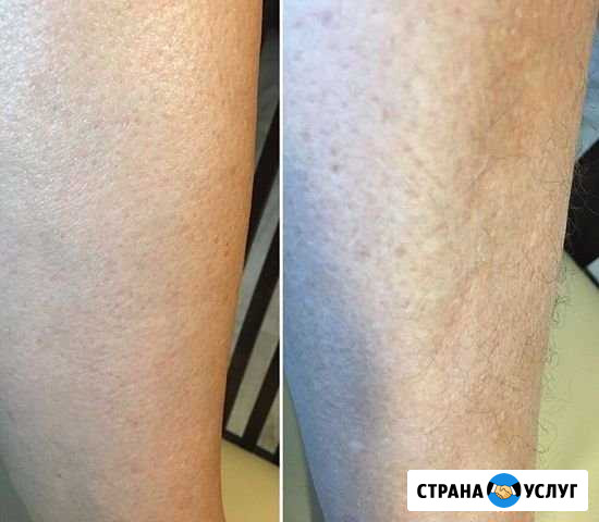 Депиляция сахар и воск Саратов - изображение 1