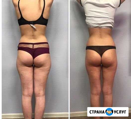 Массаж медицинский, антицеллюлитный, гуаша, детски Тверь - изображение 1