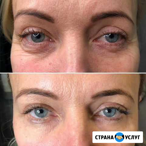 Холодная плазма Санкт-Петербург - изображение 1
