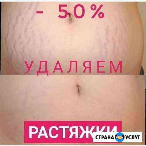 Удаление растяжек Улан-Удэ