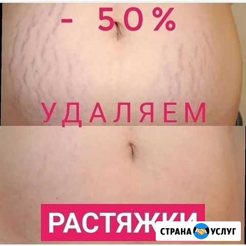 Удаление растяжек Улан-Удэ - изображение 1