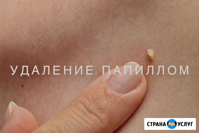 Удаление образований(папиллом и т.д) плазмой Астрахань - изображение 1