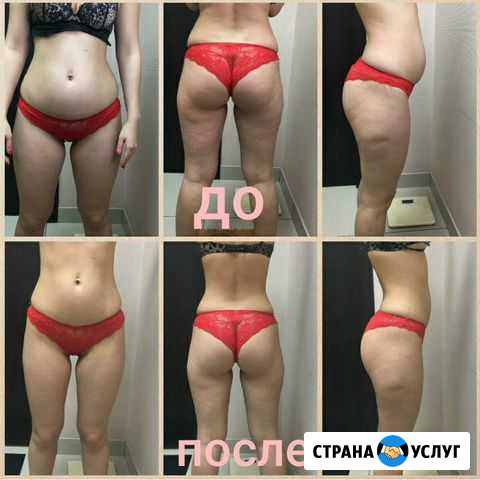 Антицеллюлитный массаж Новокузнецк - изображение 1