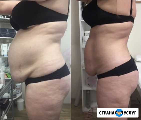 Антицеллюлитный массаж, lpg, коррекция фигуры Москва - изображение 1